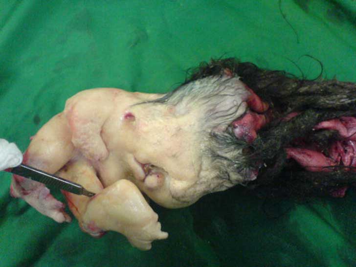 fetus-in-fetu-4