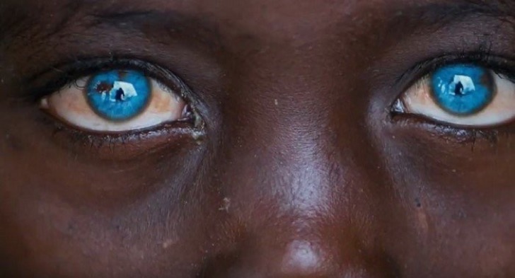 Le decían “monstruo” por el color de sus ojos. Pero luego descubrieron