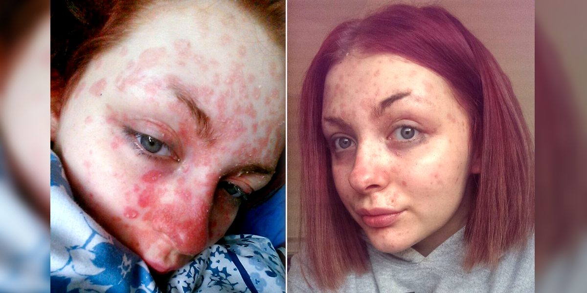 La celidonia mayor al tratamiento de la psoriasis